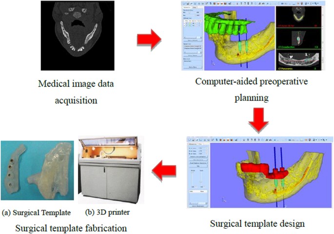 A semi-automatic computer-aided method for surgical template design | Scientific Reports – Nature Journal